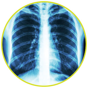 Image of an X-ray of lungs